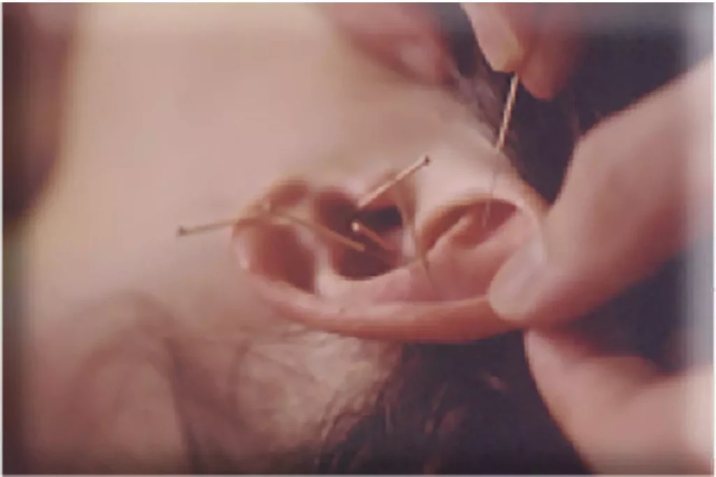 Nahaufnahme einer Ohrakupunktur mit mehreren feinen Nadeln in einem Ohr bei einer Behandlung