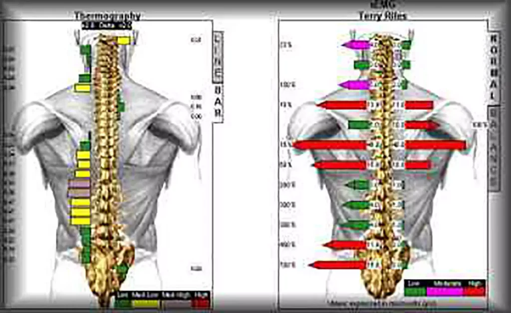 Rückansicht der Wirbelsäule mit farbigen Balken und Pfeilen zur Analyse von Fehlhaltungen und Rückenproblemen beim