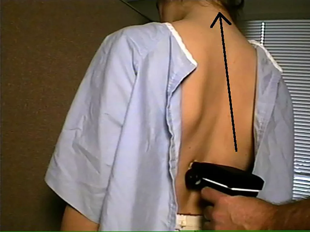 Patientin mit offenem Rücken wird mit einem Handgerät zur Wirbelsäulenuntersuchung behandelt, schwarzer Pfeil zeigt nach oben