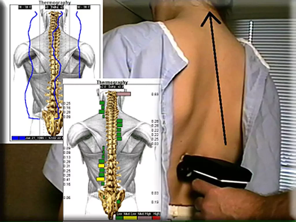 Person mit freiem Rücken wird mit Thermoscanner untersucht, daneben Grafiken der Wirbelsäule mit Messdaten und Markierungen.